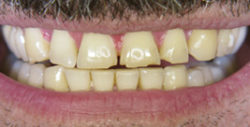 ba crowns 1 1 250x127