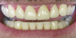 ba crowns 1 2 250x127