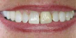 ba crowns 2 1 250x127