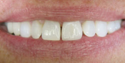 ba crowns 2 2 250x127