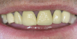ba crowns 3 1 250x127