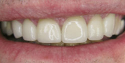 ba crowns 3 2 250x127