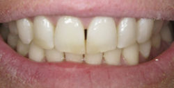 ba crowns 4 1 250x127