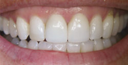 ba crowns 4 2 250x127