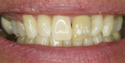 ba crowns 5 1 250x127