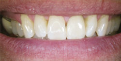 ba crowns 5 2 250x127