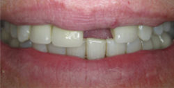 ba crowns 6 1 250x127
