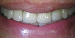 ba crowns 6 2 250x127
