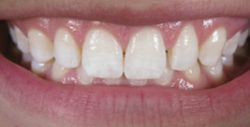 ba veneers 1 1 250x127