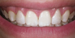 ba veneers 1 2 250x127