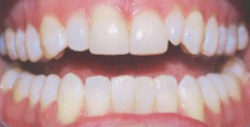 ba veneers 2 1 250x127