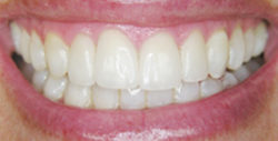 ba veneers 2 2 250x127