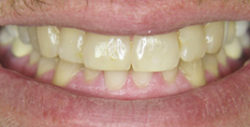 ba whitening 1 1 250x127