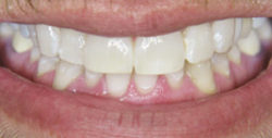ba whitening 1 2 250x127