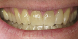 ba whitening 2 1 250x127