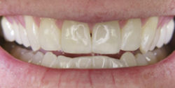 ba whitening 2 2 250x127