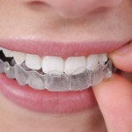 bloginvisalign