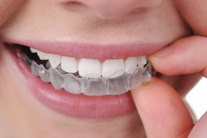 bloginvisalign