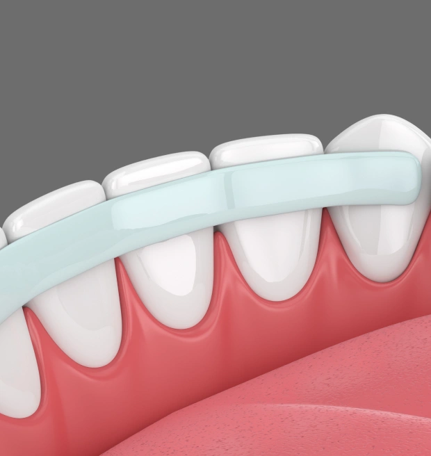 Composite Bonding