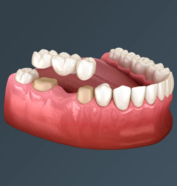 Dental Bridges