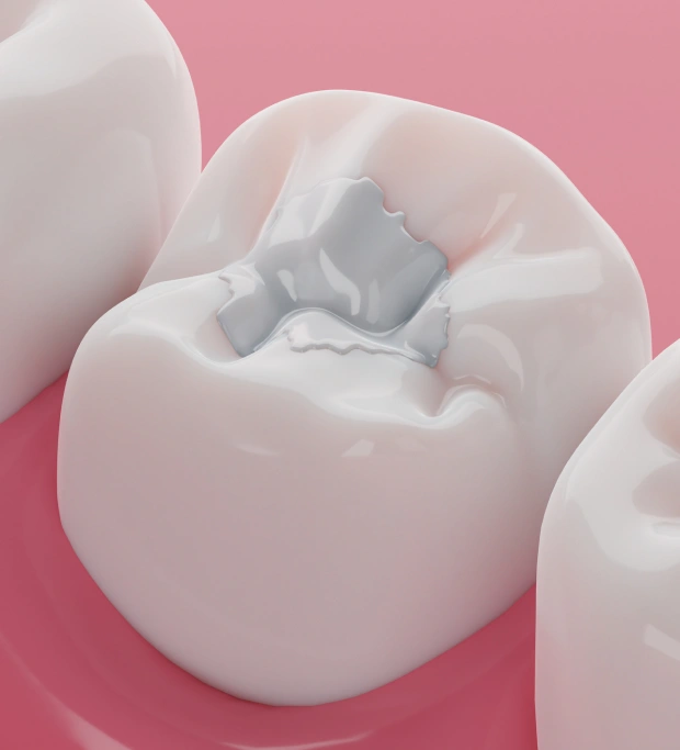 Treat Cavities Early With a Restoration That Looks Natural