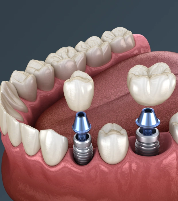 Dental implant crowns