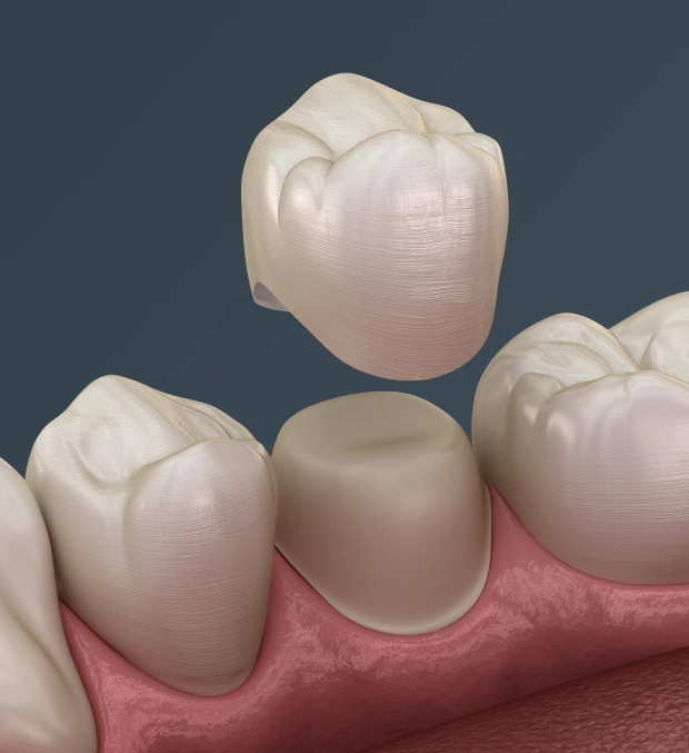 Porcelain Crowns